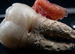 Cuando un diente se cae sin dolor: el silencio clínico que revela una enfermedad profunda