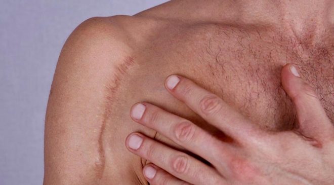 Las cicatrices no son solo estéticas: pueden provocar dolor, limitar el movimiento y afectar a la calidad de vida